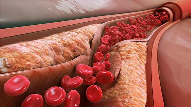 Las LDL se han asociado con la progresión de la aterosclerosis. En la imagen, ateromas causados por la acumulación de LDL en la pared de la arteria. Imagen: Manu5 – Wikimedia. http://www.scientificanimations.com/wiki-images/