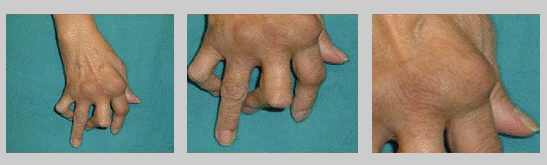 Efectes a llarg termini a la mà d'un pacient de artritis reumatoide.